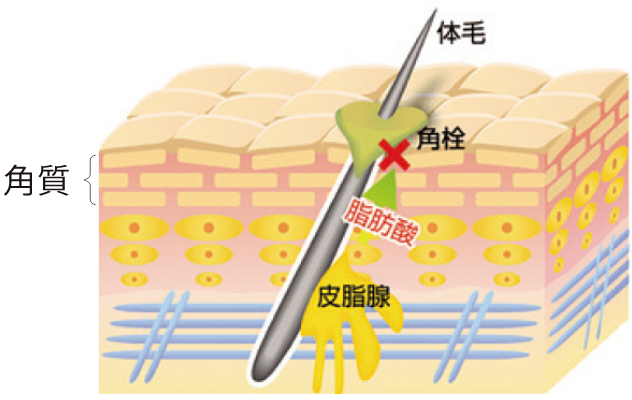 角栓が毛穴を塞ぐイメージ